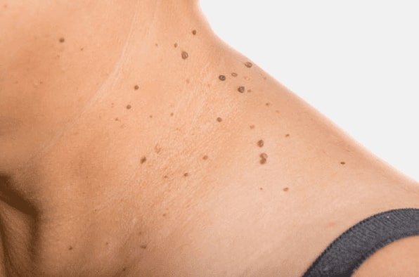 Are you looking for easy skin tag removal Beeston Hill - then contact Spire today!