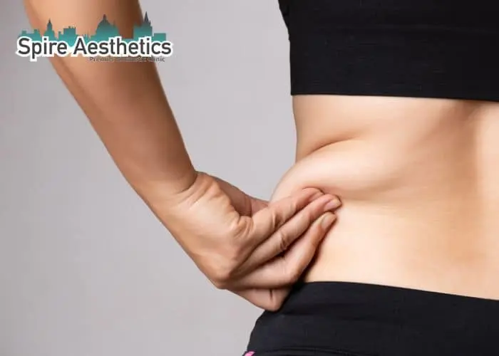 Image of woman pinching fat on their hips Beeston Hill. Fat Freezing treatment