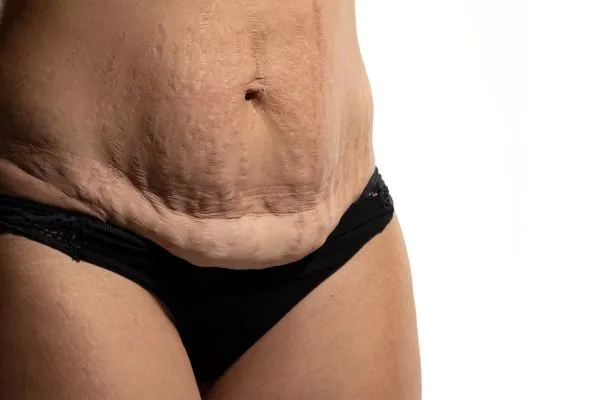 Image of womans stomach after weight loss injections Beeston Hill showing saggy skin